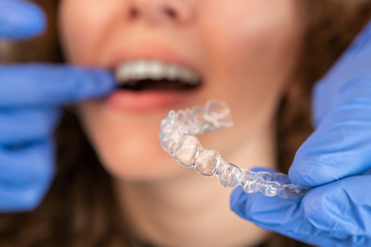 A person wearing blue gloves holds a clear dental aligner in front of someone’s open mouth, preparing to insert it.