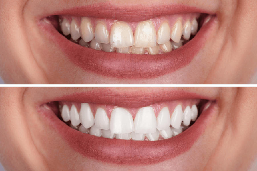 Close-up, side-by-side comparison of teeth before and after whitening. Top image shows yellowed teeth, the bottom shows bright, white teeth.