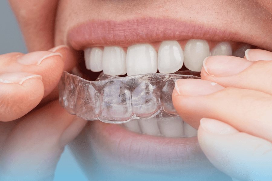 Person inserting a custom night guard to protect teeth from grinding