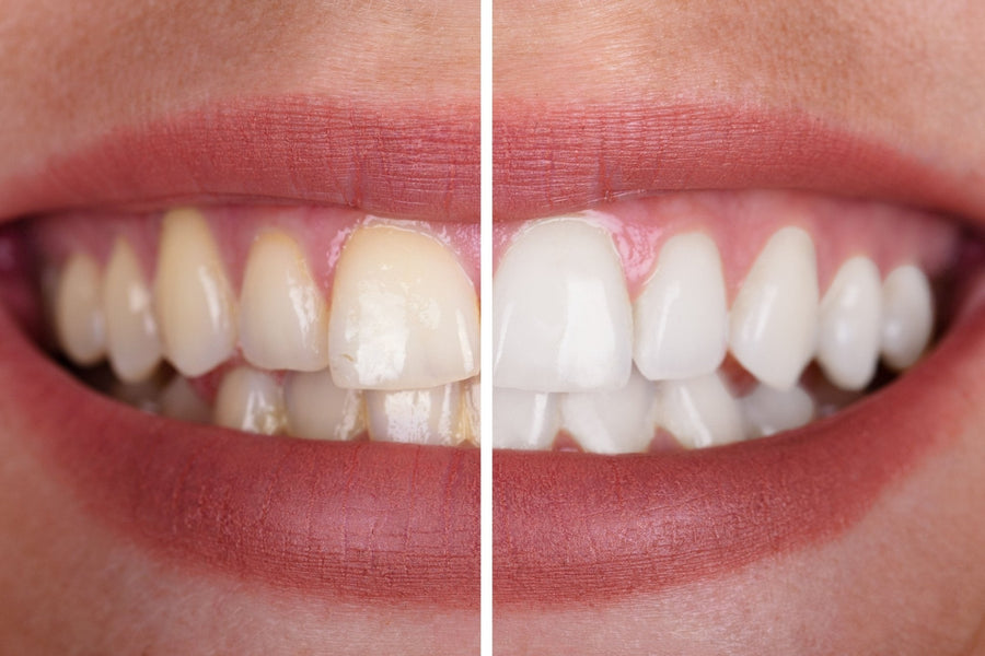 Close-up of a smile showing a side-by-side comparison of teeth before and after whitening — the left side is yellowed, and the right side is noticeably whiter and brighter.