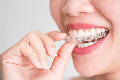 Woman putting a clear Invisalign aligner on her teeth before starting Invisalign treatment