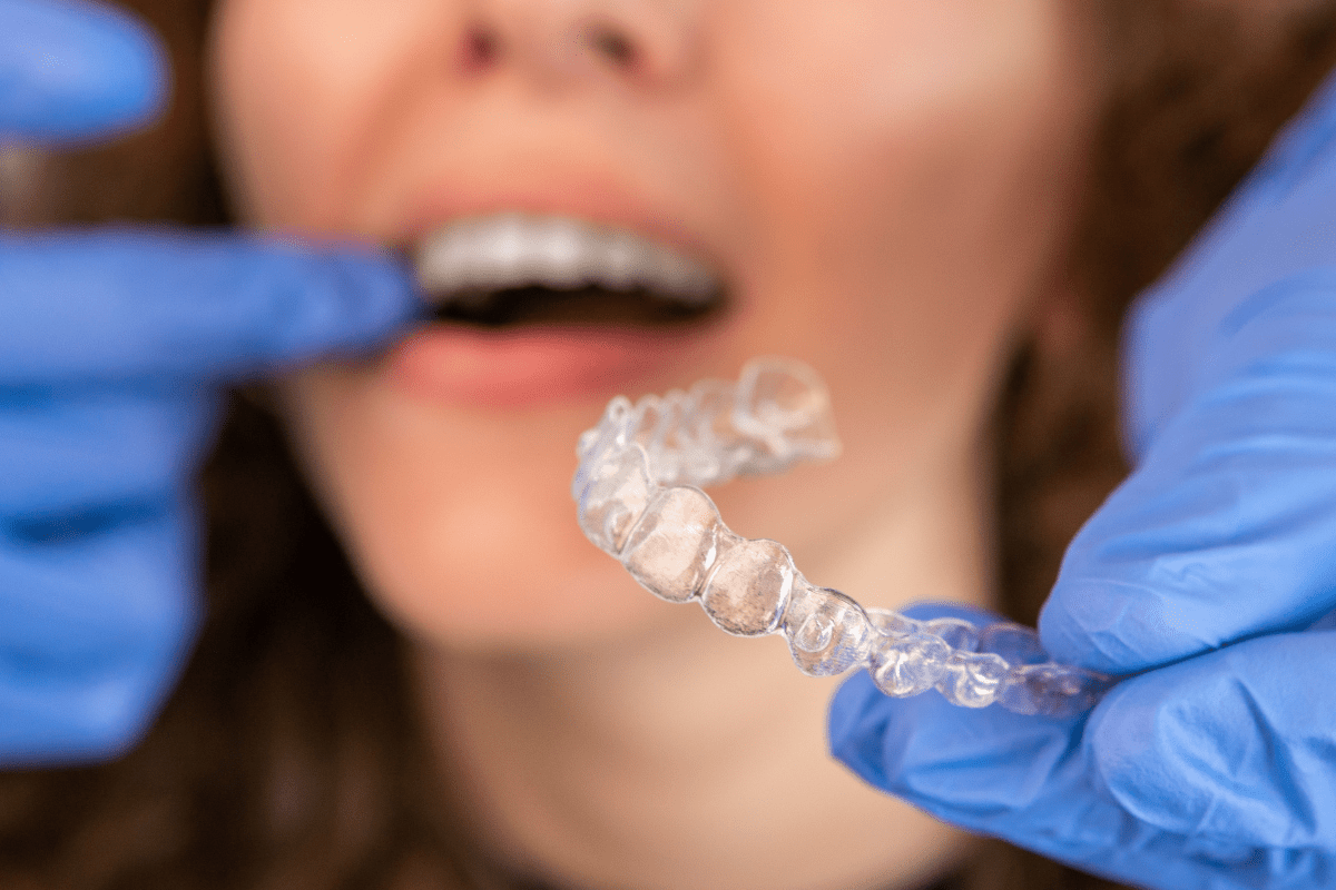 A person wearing blue gloves holds a clear dental aligner in front of someone’s open mouth, preparing to insert it.