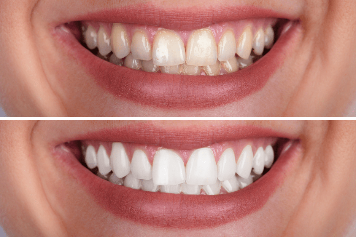 Close-up, side-by-side comparison of teeth before and after whitening. Top image shows yellowed teeth, the bottom shows bright, white teeth.