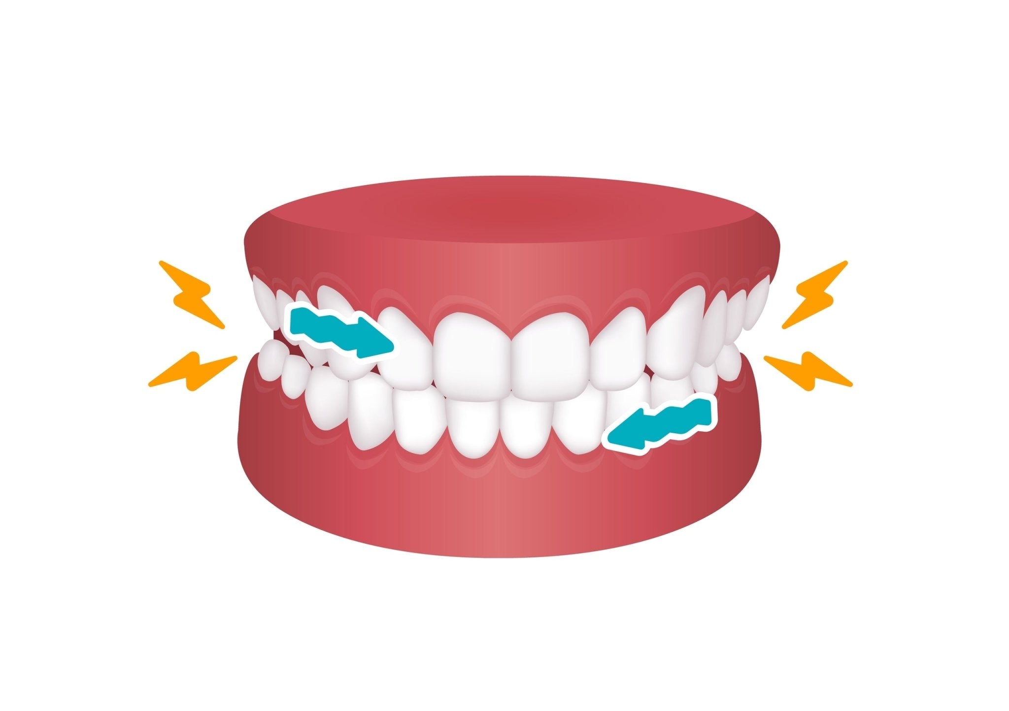 How Brux Night Guards Protect Against Teeth Grinding Damage