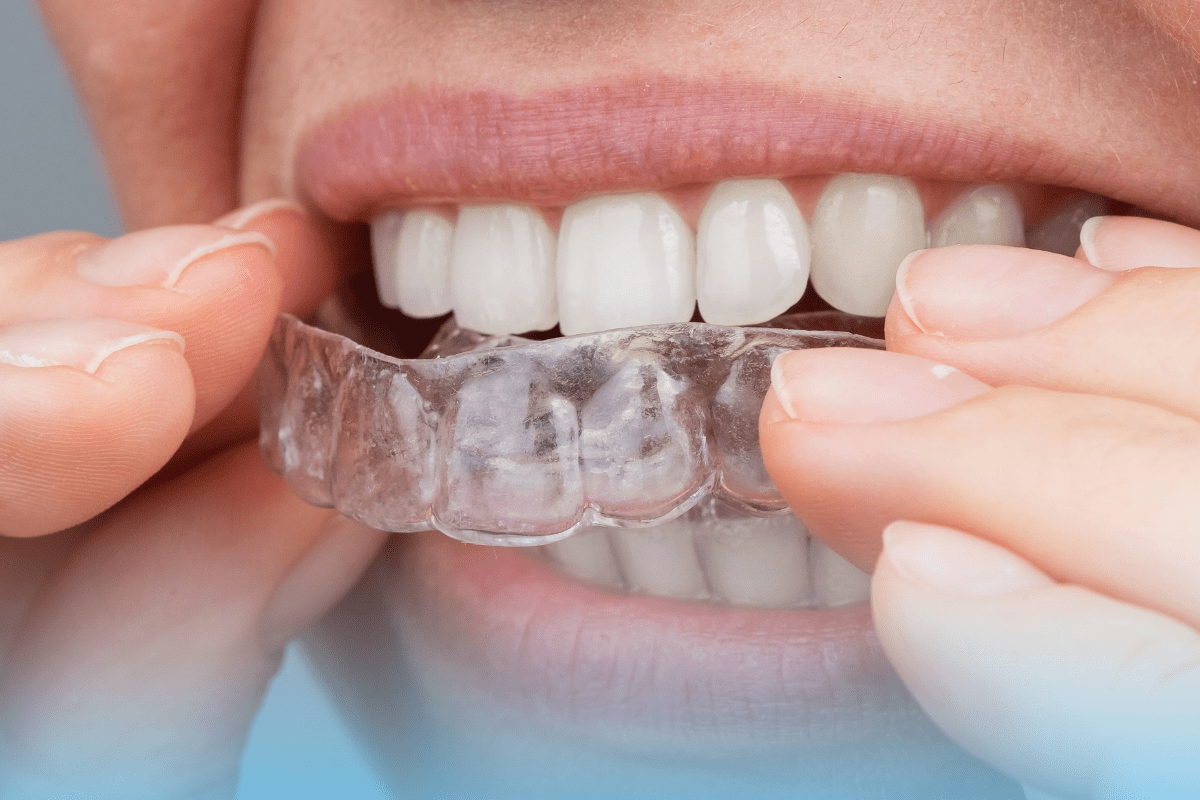 Person inserting a custom night guard to protect teeth from grinding