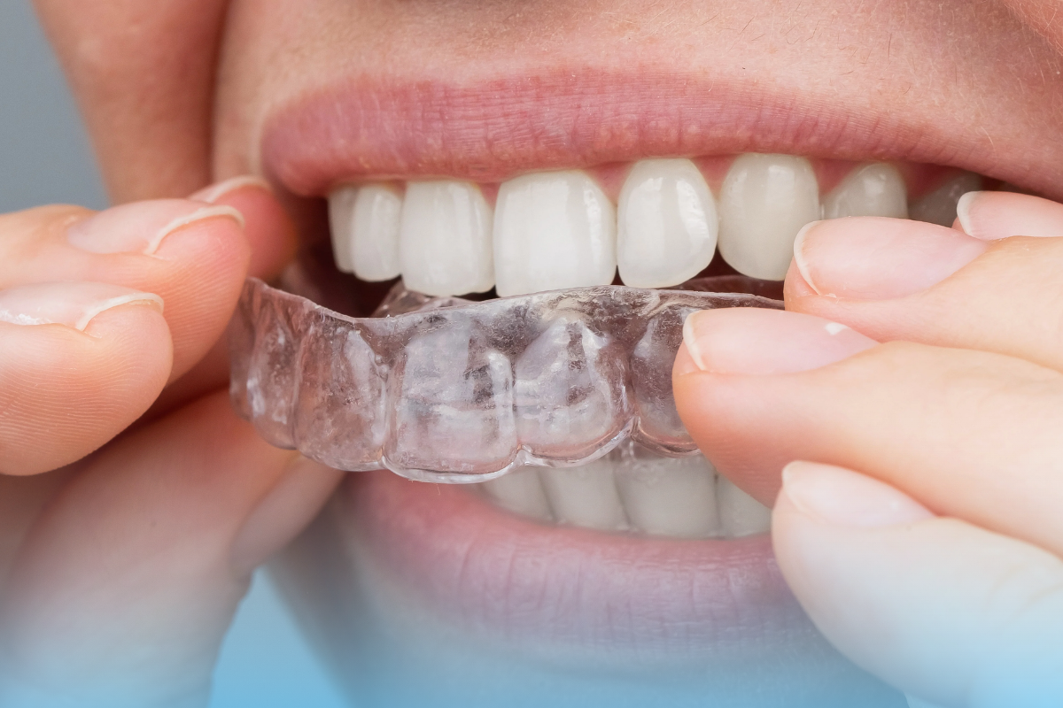 Person inserting a custom night guard to protect teeth from grinding