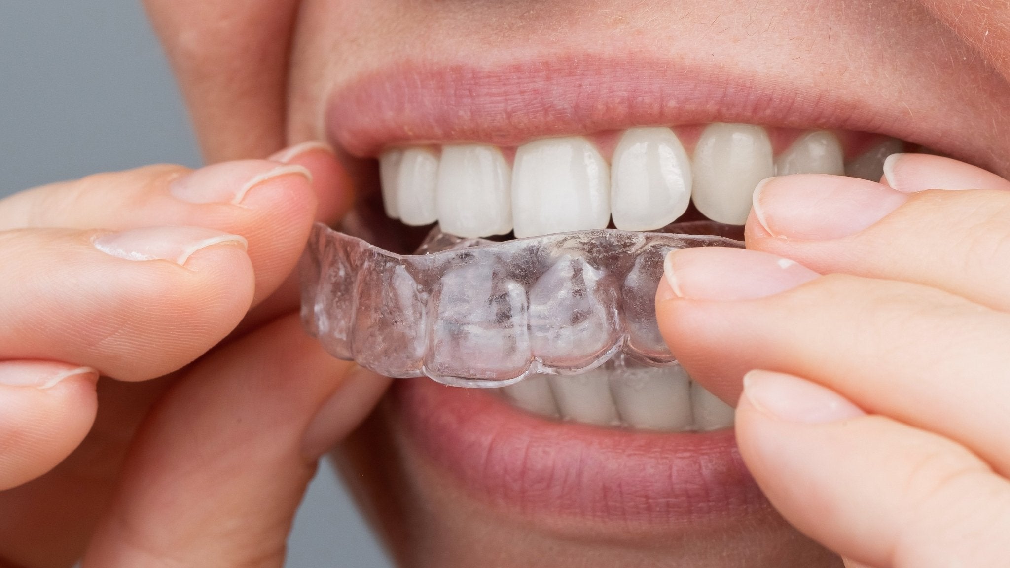 What Is an Occlusal Guard, and How Does It Work?