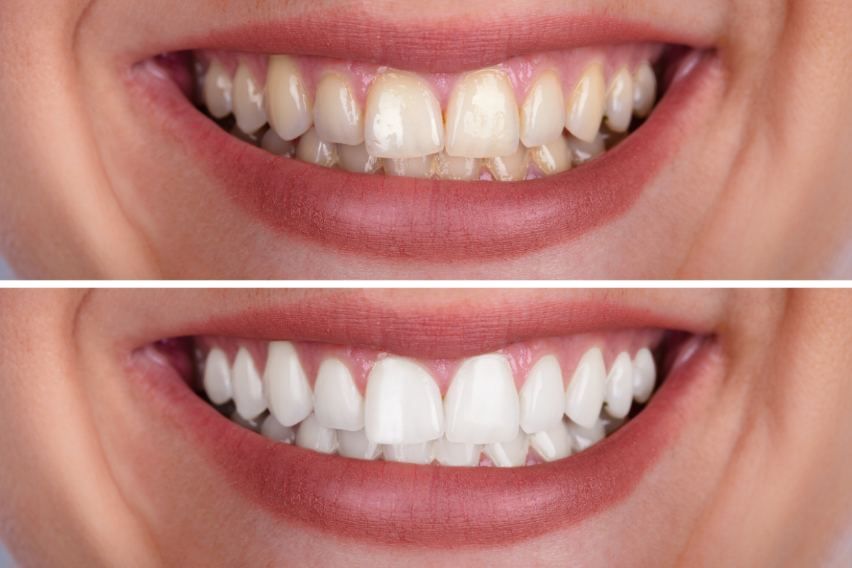 Close-up, side-by-side comparison of teeth before and after whitening. Top image shows yellowed teeth, the bottom shows bright, white teeth.