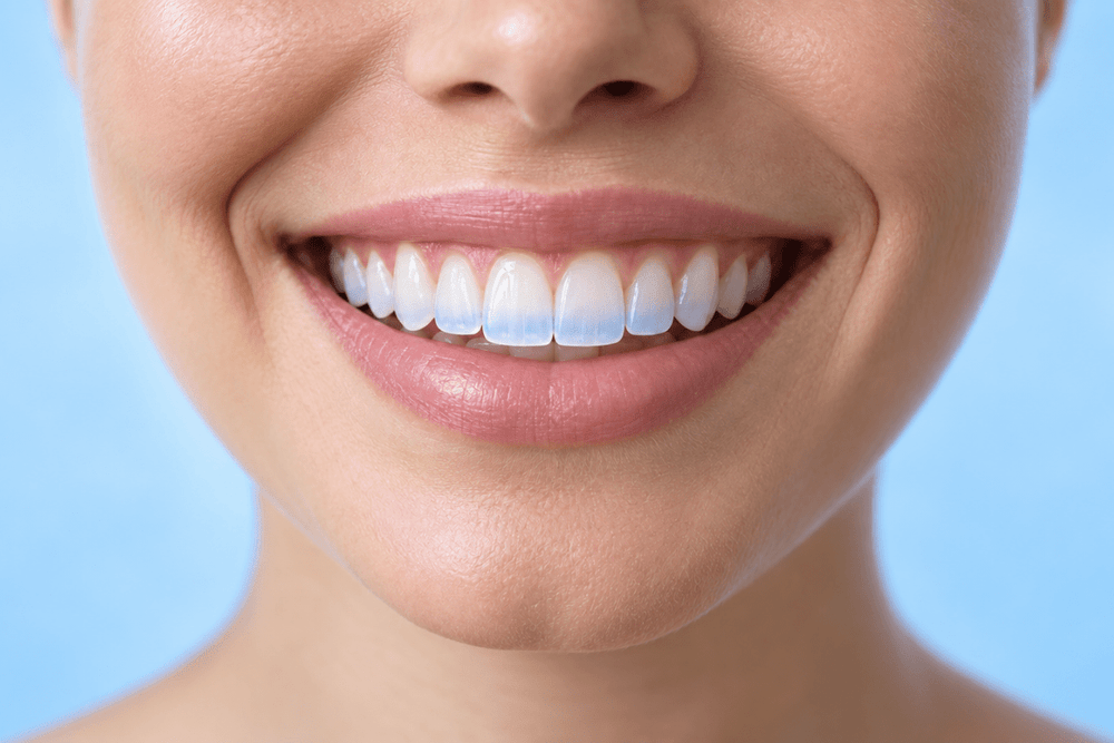 Close-up of a smiling person with translucent front teeth showing see-through enamel along the edges