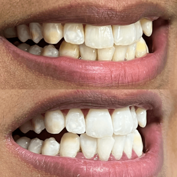Teeth bleaching