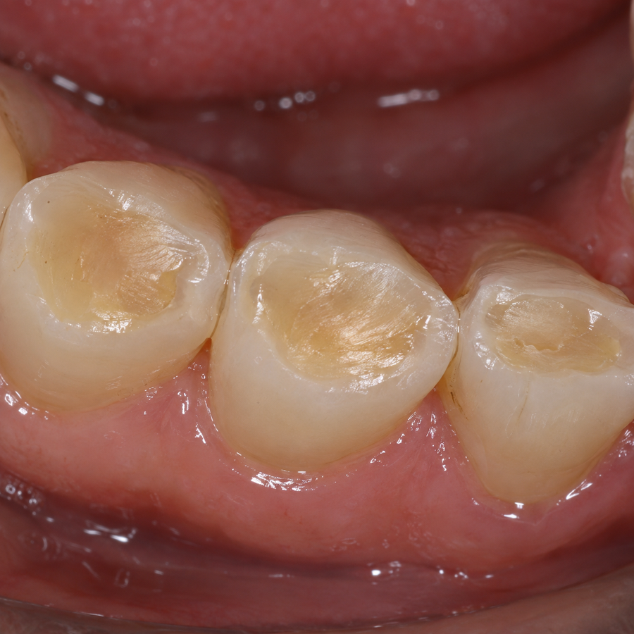 Three back teeth with broad yellow centers surrounded by pale rims