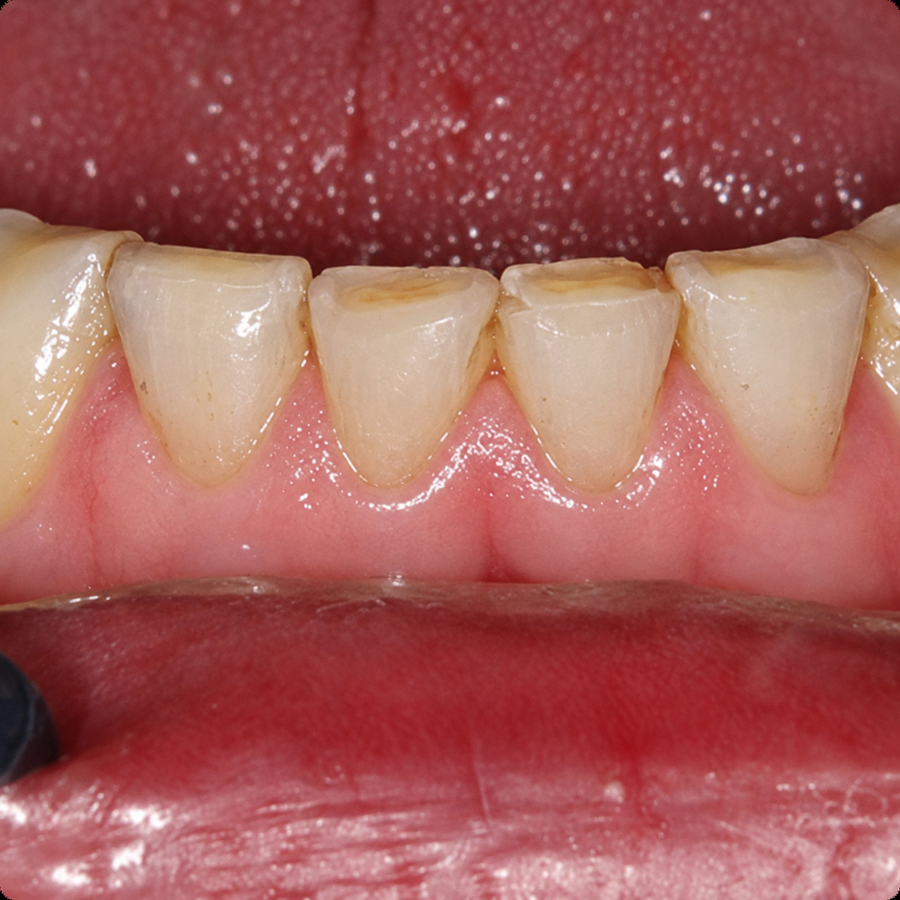 Lower front teeth with flattened biting surfaces and yellow centers