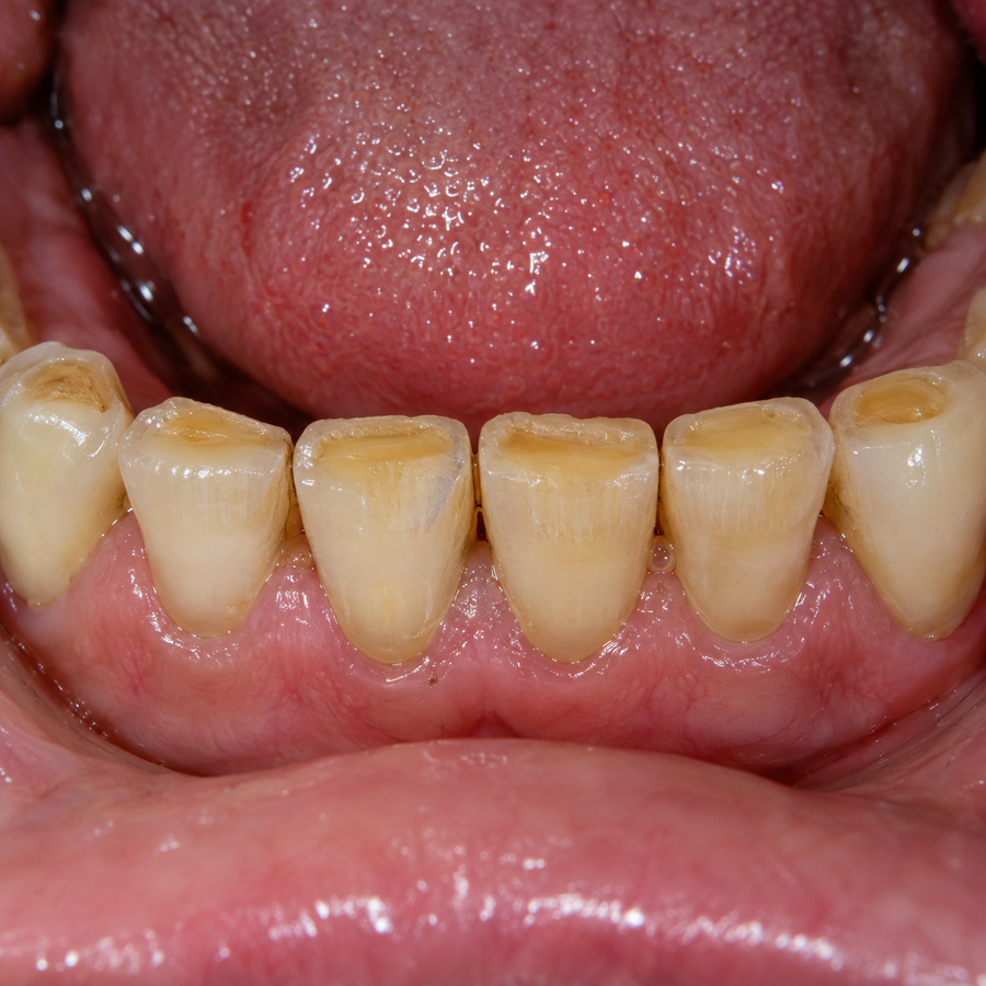 Lower incisors and canines with broad yellow areas on the biting surfaces